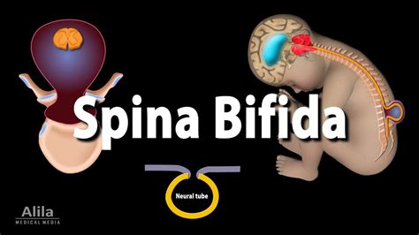 bufuda|Spina Bifida 